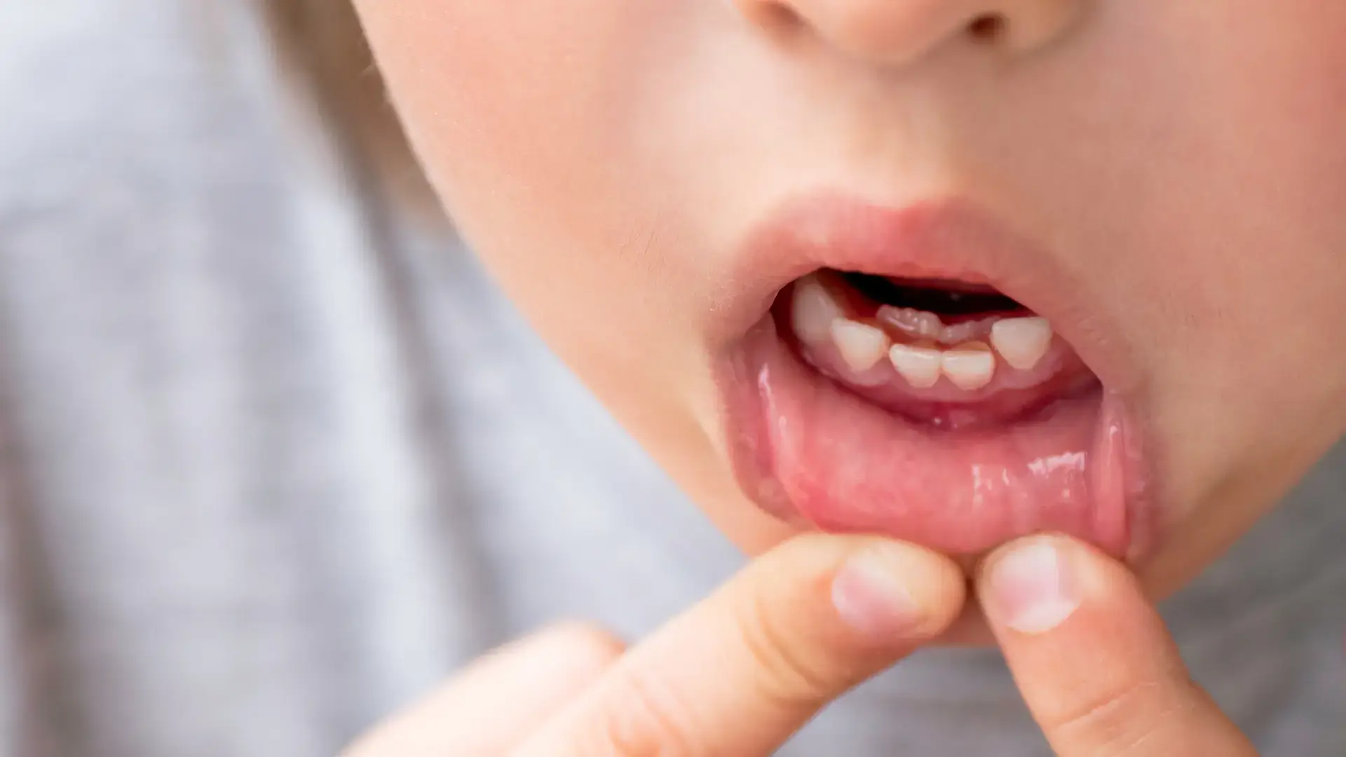 Afty i pleśniawki - częsty problem w jamie ustnej. Jak sobie z nimi radzić?